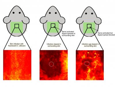 A New Type of Immunity: Pain Sensing Nerves in the Skin Help Fight Infection