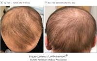 Hair Regrowth in Alopecia Patient Treated with Dupilumab