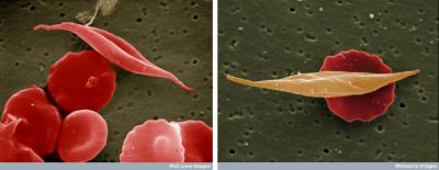 Normal and Sickle Red Blood Cells