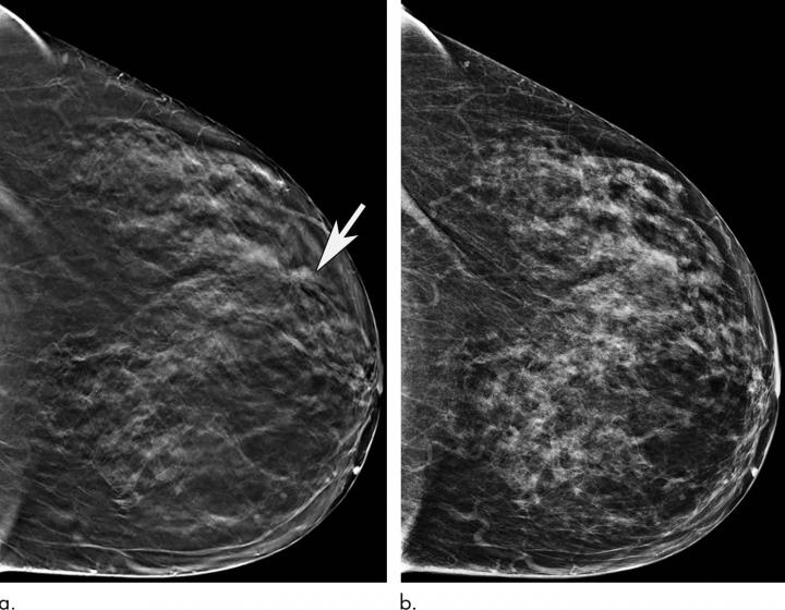 Older Women Benefit Significantly When Screened with 3-D Mammography