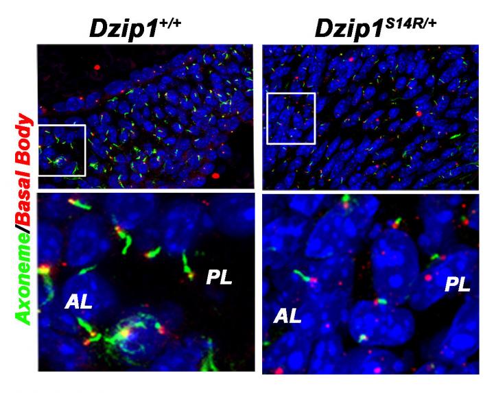 Defects in Cellular Antennae Can Cause a Common Heart Condition (3 of 3)
