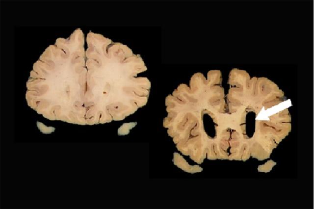 Comparison of normal brain and brain with atrophy