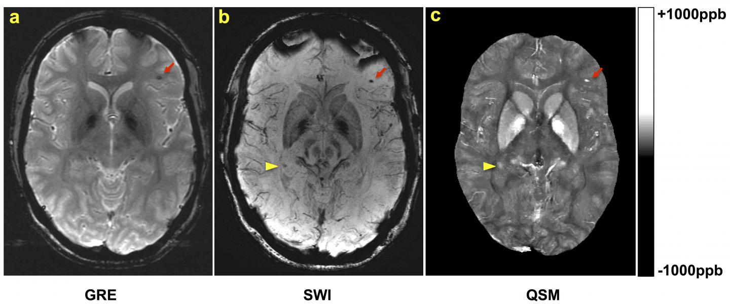 traumatic-brain-injury-image-eurekalert-science-news-releases