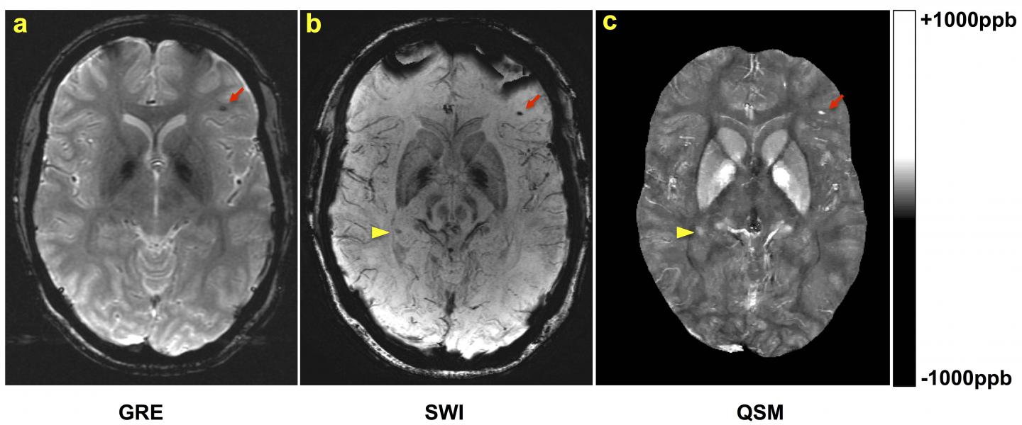 Traumatic Brain Injury