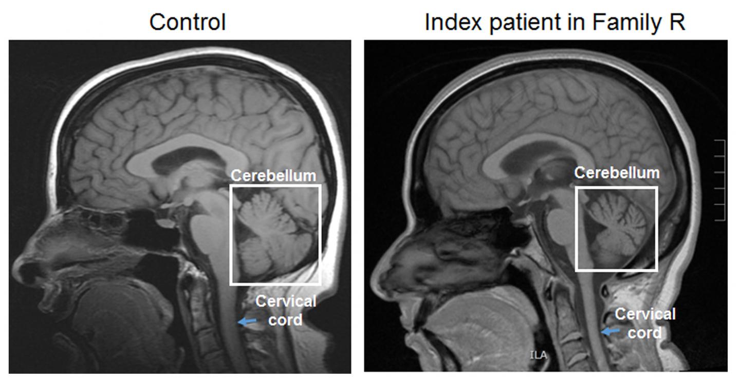 ataxia-patient-mri-image-eurekalert-science-news-releases