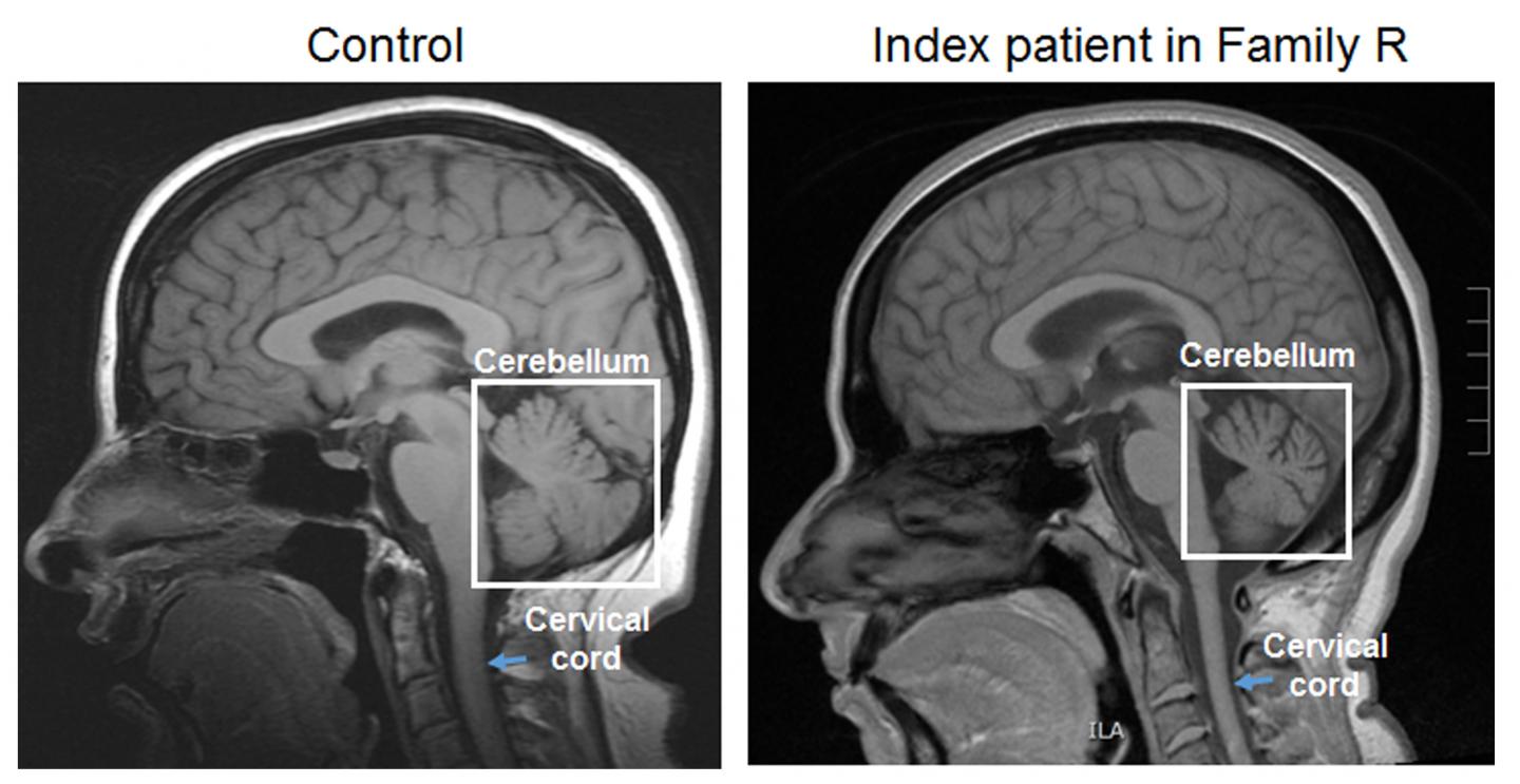 Ataxia Patient MRI