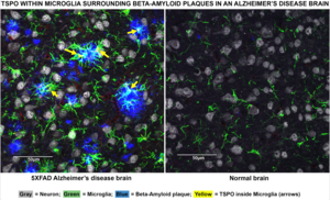 TSPO within Microglia Surrounding Beta-Amyloid Plaques in an Alzheimer's Disease Brain