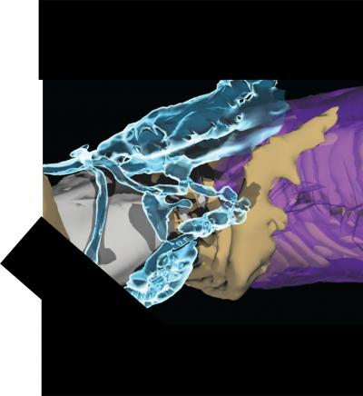Node of Ranvier with Detaching Myelin