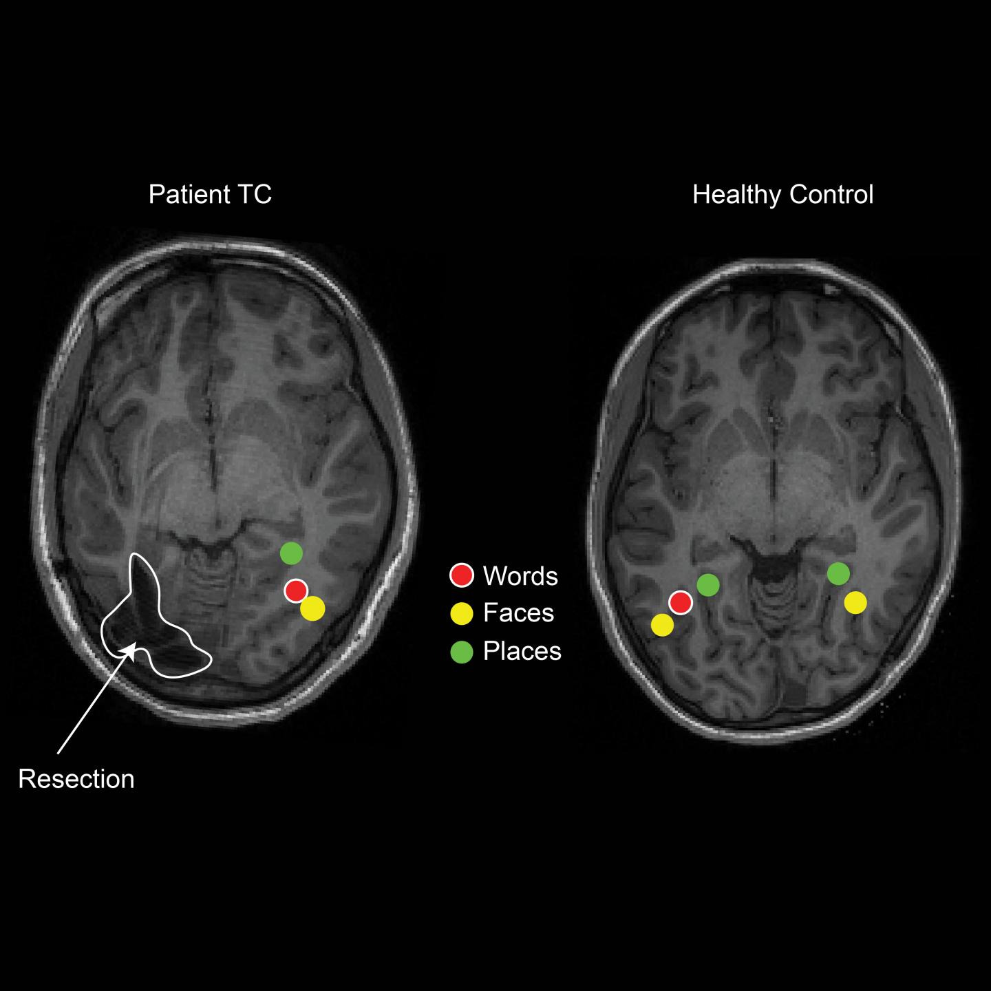 Visual Perception Rewired After Surgery for Epilepsy