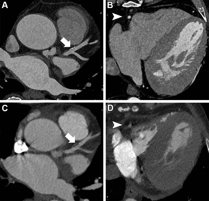 Images in a 67-year-old man with severe aortic valve stenosis recurrence after surgical aortic valve replacement 6 years ago.