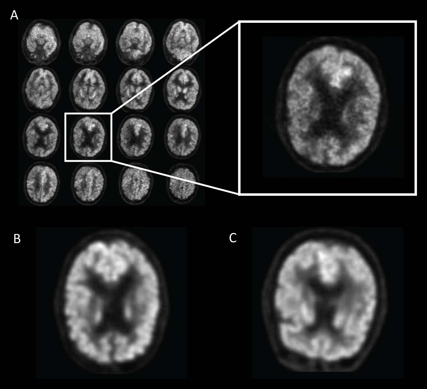 Example of Fluorine 18 fluorodeoxyglucose PET Images from Alzheimer's Disease