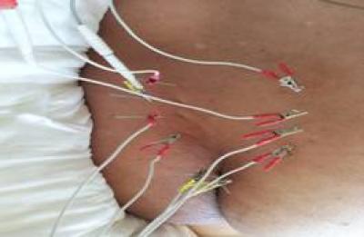 Electroacupuncture