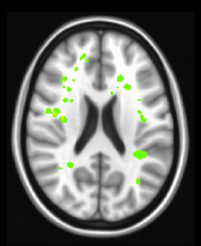 Silent Strokes in the White Matter