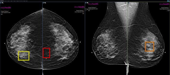 AI enhanced screening mammography.