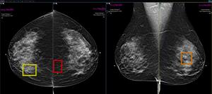 AI enhanced screening mammography.