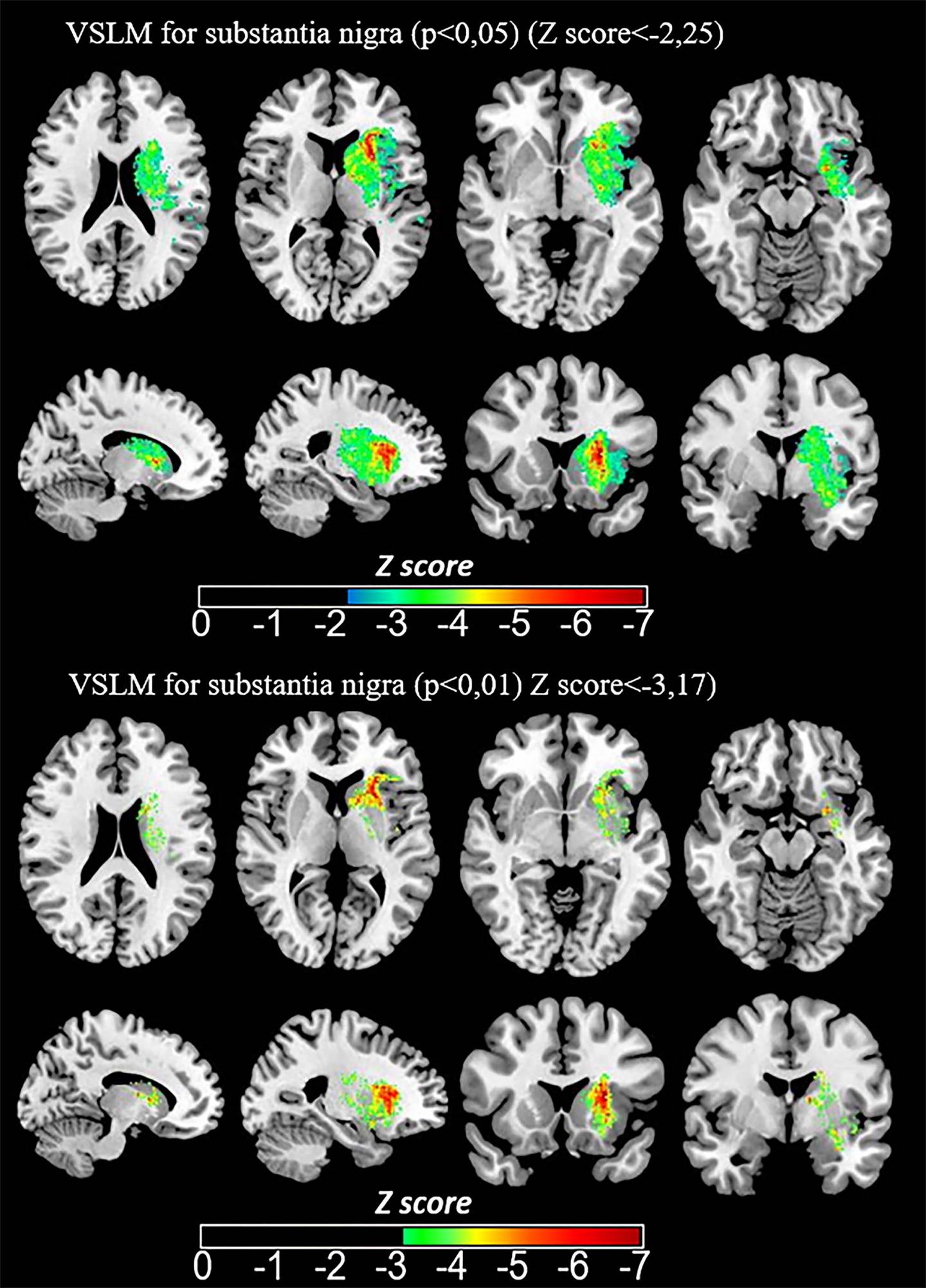 Iron Measurements with MRI Reveal Stroke's Impact on Brain (3 of 3)