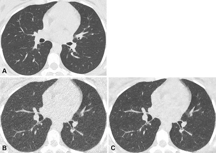 Noncontrast chest CT lung window images in a 42-year-old male participant with normal lungs