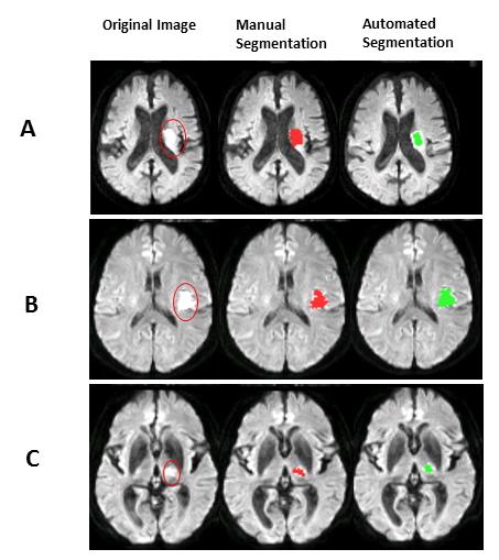 Lesion Segmentation