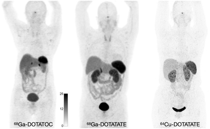 Normal biodistribution of 68Ga-DOTATOC, 68Ga-DOTATATE, and 64Cu-DOTATATE.