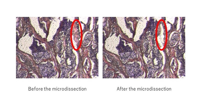 Amyloid mass before and after microdissection