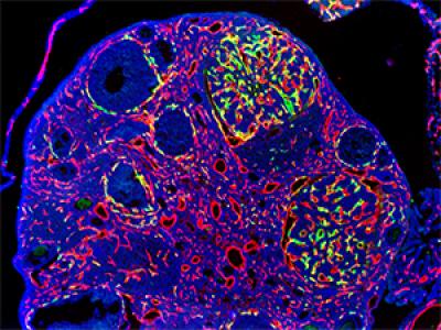 Gene Therapy Method Targets Tumor Blood Vessels