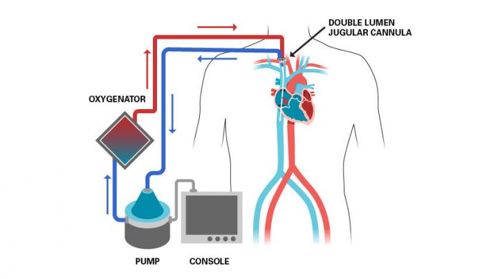 ECMO circuit