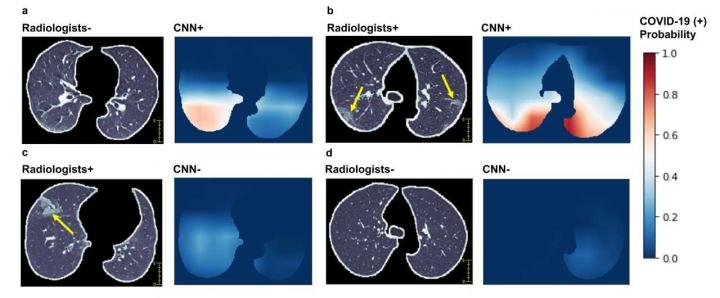 Examples of chest CT images of COVID-19 (+) patients and visualization of features correlated to COVID-19 positivity