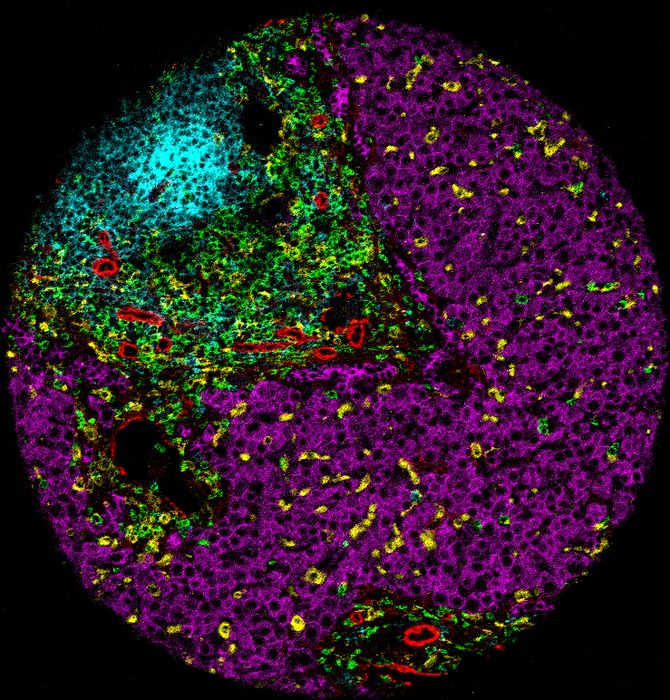 Staining of immune tumor