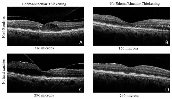 Four types of diabetic eyes