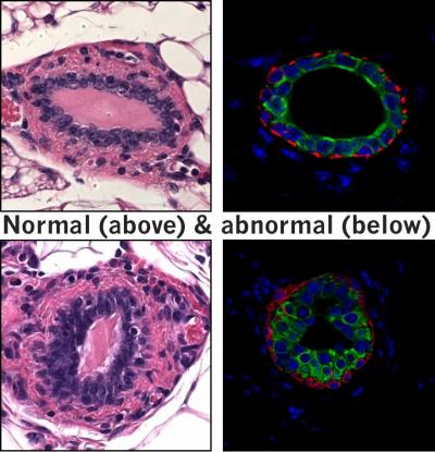 Normal and Abnormal Breastmilk Cells (2 of 3)