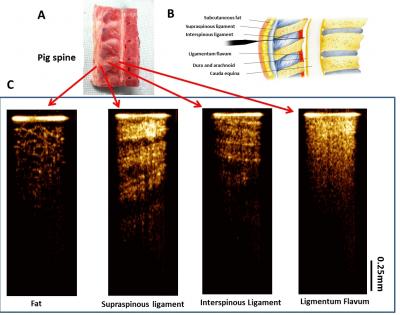 Precision-Guided Epidurals