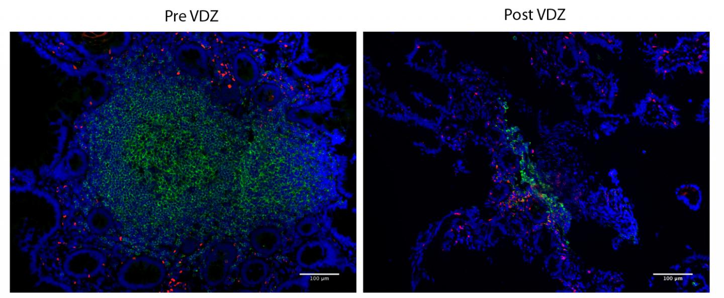 Inflammatory Bowel Disease Drug Attacks Safe Haven for HIV (2 of 2)