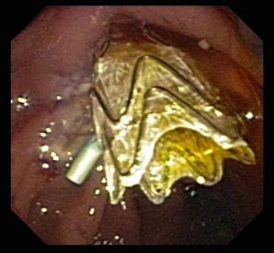 Coated Self-Expanding Metallic Stent in Place