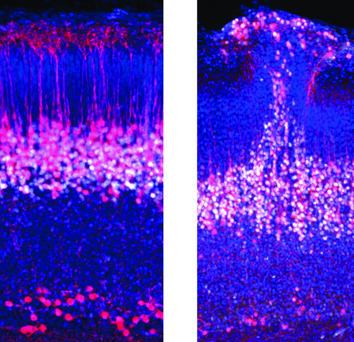 WT vs Autism Cortex