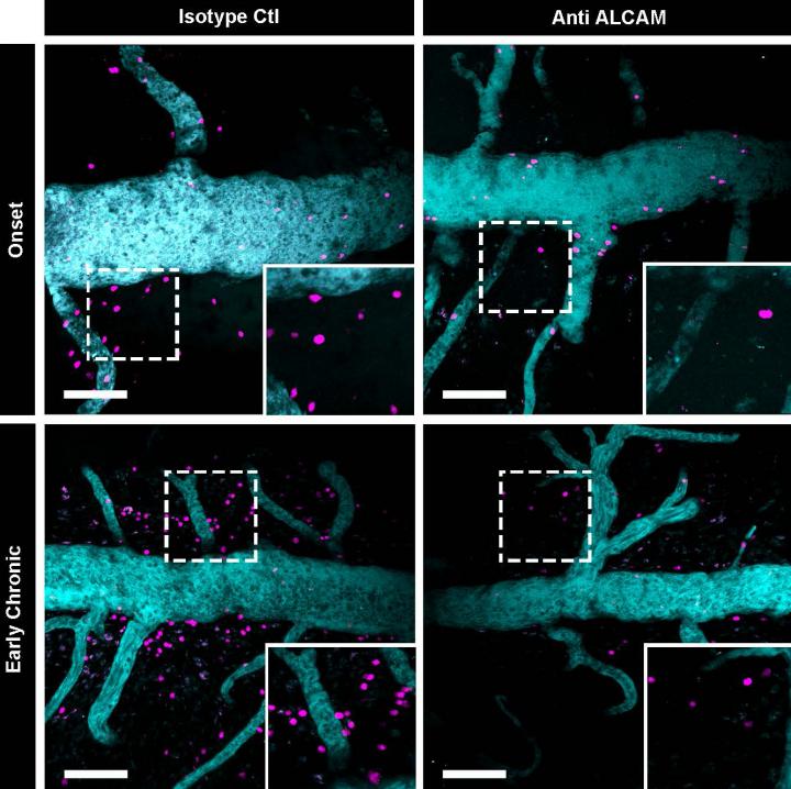 How B Cells Vault the Body's Barriers in Multiple Sclerosis (1 of 3)