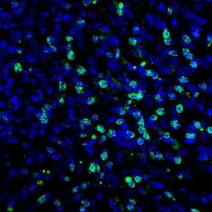 Treatment with ranolazine increases the number of antitumour lymphocytes that infiltrate the tumour and favour the action of immunotherapy