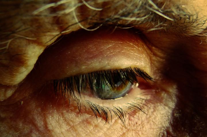 Alzheimer's Disease Thought to be Accelerated by an Abnormal Build-up of Fat in the Brain