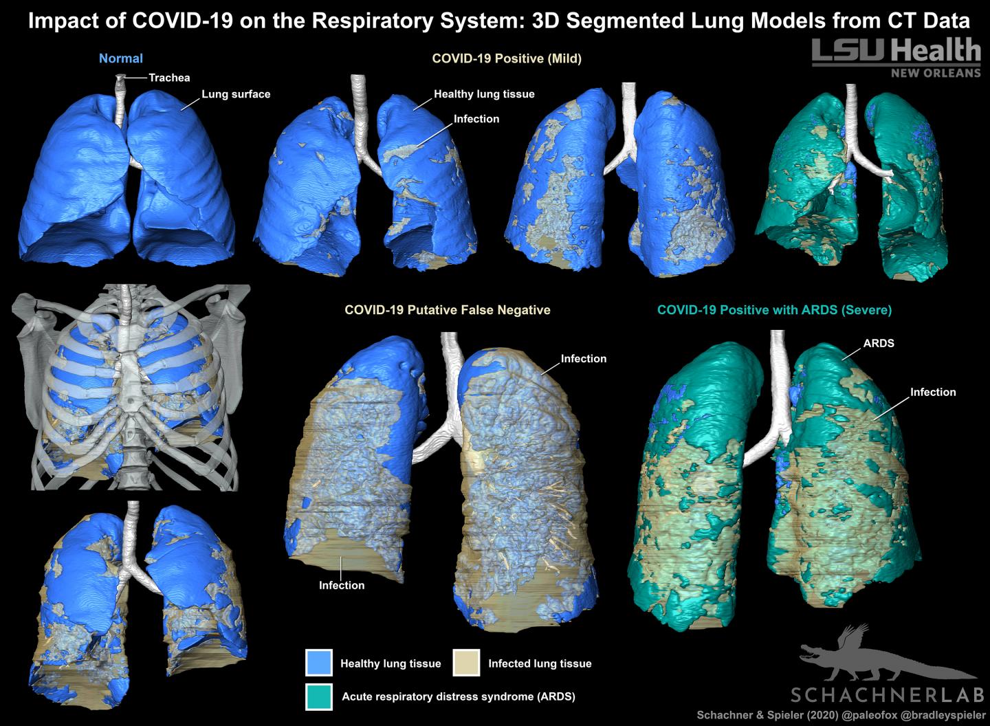 Impact of COVID-19 on the Respiratory System: 3D Segmented Lung Models from CT Data
