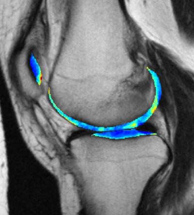 Spotting Subtle Patterns In Knee Cartilage