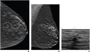 72-year-old woman recalled from screening mammography for architectural distortion in left breast