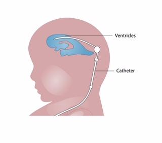 Shunt placement in ventricles
