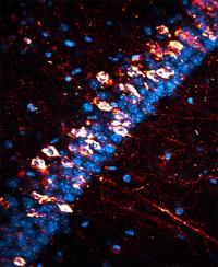 Neurofibrillary Tangles Are 1 of the Hallmarks of Alzheimer's Disease