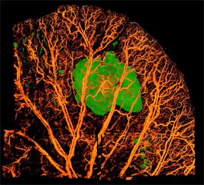 Successful Filler Injection