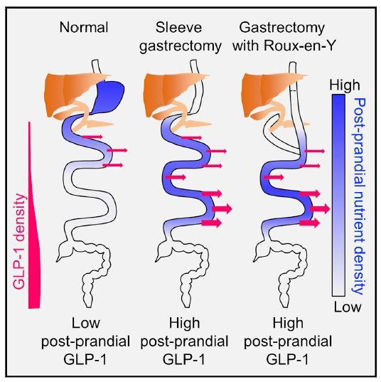 Bariatric Surgery Graphical Abstract