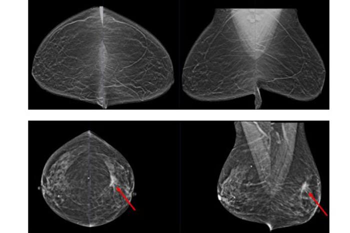 Mammograms with and without cancer