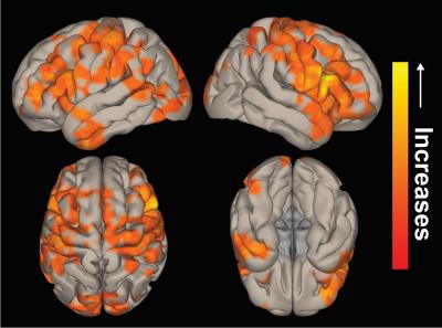 Brain Network Activity Can Improve in Epilepsy Patients after Surgery