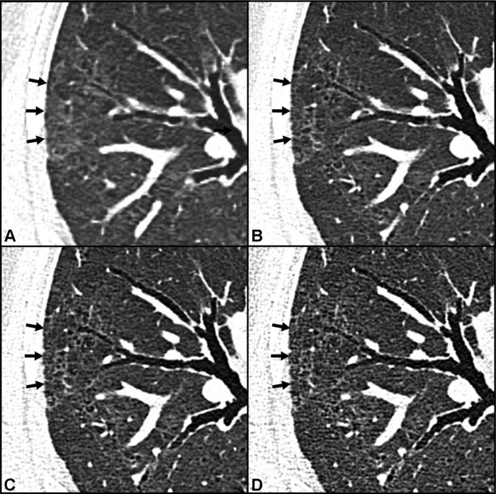 Photon-Counting CT Shows More Post-COVID-19 Lung Damage