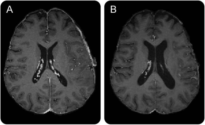 Effects of Chemoradiation on Healthy Brain Tissue of Glioblastoma Patients