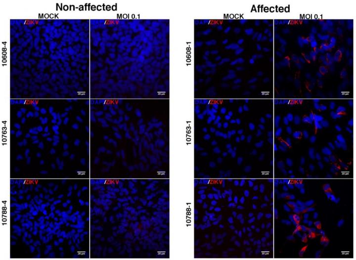 Cells Derived From Babies Born With the Congenital Zika Syndrome
