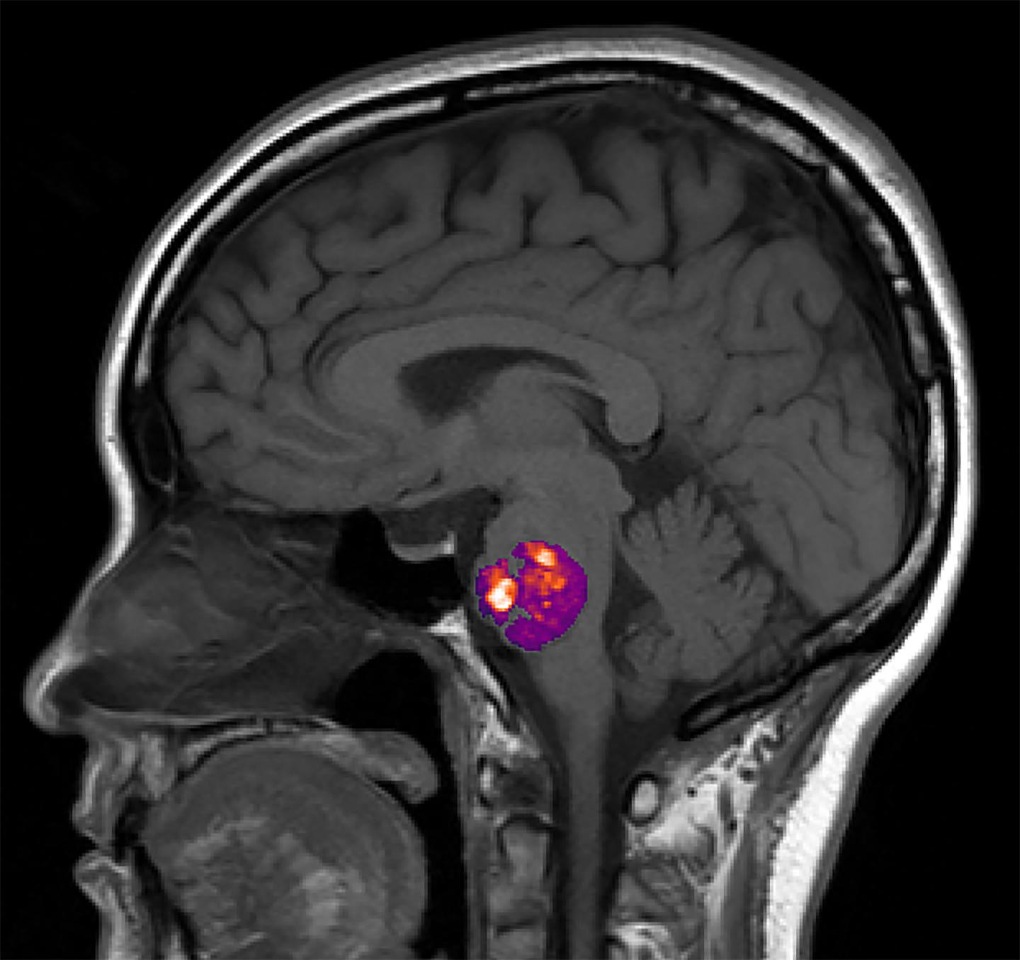 Stroke and Gut Bacteria